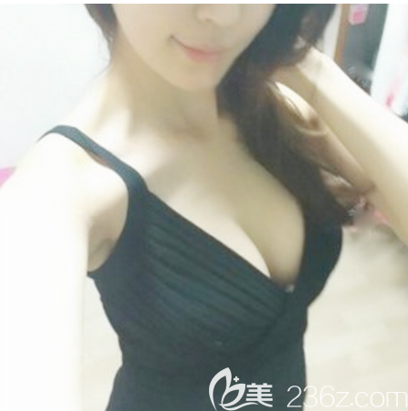 假体隆胸术后7天拆线