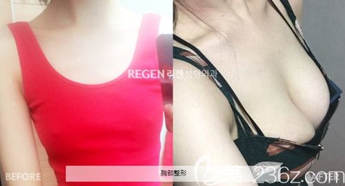 韩国丽珍假体隆胸手术案例