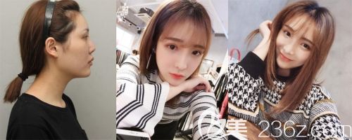 韩国丽珍鼻部整形案例