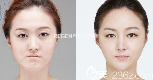 韩国丽珍PRP脂肪填充案例