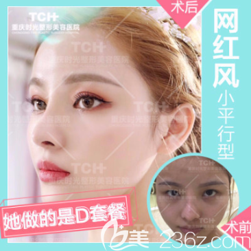 重庆时光割双眼皮怎么样