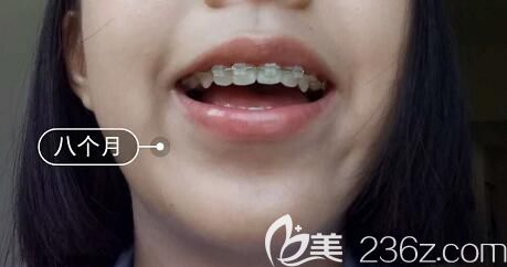 我在洛阳九龙口腔做牙齿矫正第8个月