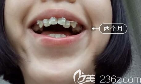 我在洛阳九龙口腔做牙齿矫正第2个月