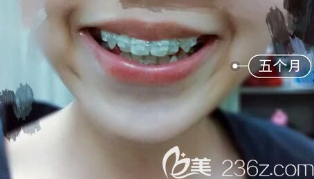 我在洛阳九龙口腔做半隐形陶瓷托槽牙齿矫正5个月