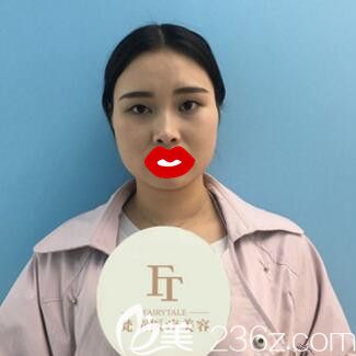 做双眼皮术前照 做双眼皮术前照