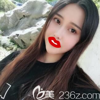 做眼综合+瘦脸术后29天<span style= 做眼综合+瘦脸术后29天<span style=