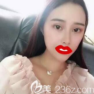 在长沙做双眼皮开眼角注射瘦脸术后45天<span style= 在长沙做双眼皮开眼角注射瘦脸术后45天<span style=