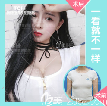 重庆时光整形假体隆胸 重庆时光整形假体隆胸