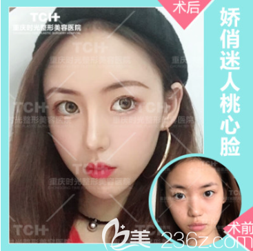 重庆时光整形自体脂肪丰苹果肌 重庆时光整形自体脂肪丰苹果肌