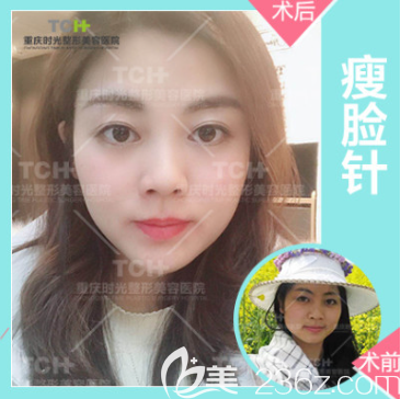 重庆时光医院打瘦脸效果 重庆时光医院打瘦脸效果