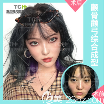 重庆时光整形能磨骨改脸型吗 重庆时光整形能磨骨改脸型吗