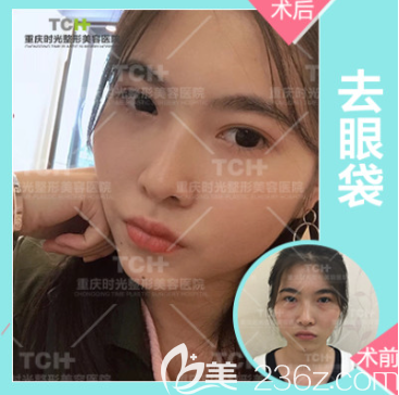 重庆时光整形能祛眼袋吗 重庆时光整形能祛眼袋吗