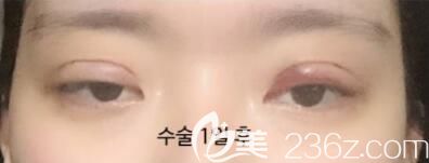 韩国美丽的人双眼皮+开眼角+眼部吸脂案例术后恢复效果图