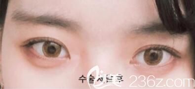 考虑韩国和国内双眼皮技术差别找韩国美丽的人整形外科做眼综合案例术后1个月恢复效果图