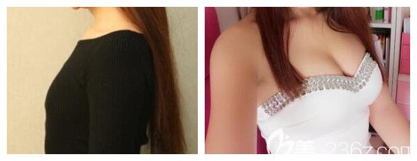 南宁韩成整形高静医生自体脂肪丰胸案例