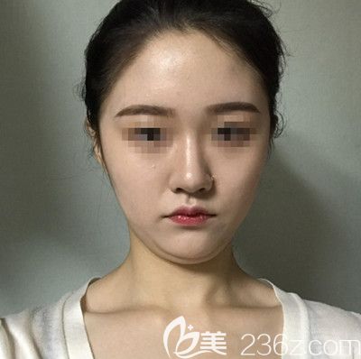 在韩国DI整形医院做面部吸脂+垫下巴手术前 在韩国DI整形医院做面部吸脂+垫下巴手术前