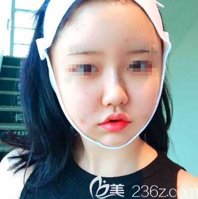 在韩国DI整形医院做面部吸脂+垫下巴手术当天 在韩国DI整形医院做面部吸脂+垫下巴手术当天