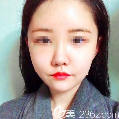 在韩国DI整形医院做面部吸脂+垫下巴手术后9天 在韩国DI整形医院做面部吸脂+垫下巴手术后9天