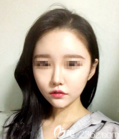 在韩国DI整形医院做面部吸脂+垫下巴手术后1个月 在韩国DI整形医院做面部吸脂+垫下巴手术后1个月