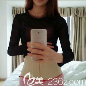 汪洋主任帮我做腰腹吸脂术后即刻 汪洋主任帮我做腰腹吸脂术后即刻