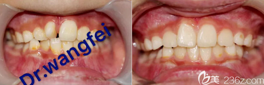 杨占娟院长恒牙萌出异位早期干预案例效果 杨占娟院长恒牙萌出异位早期干预案例效果