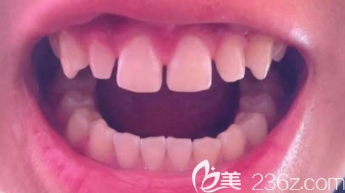 闫立文医生解析树脂补门牙有缝隙后悔了该如何补救 闫立文医生解析树脂补门牙有缝隙后悔了该如何补救