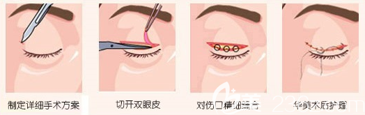 汕头华美双眼皮手术过程图