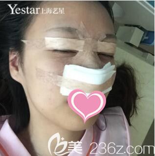 上海艺星医疗美容医院李建兵美杜莎精雕媚眼+翘鼻小鼻综合真人案例术后第2天
