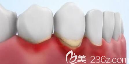 洛阳九龙口腔史万丽介绍牙周炎的治疗方法