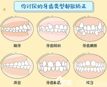 汕头华美能够矫正不同牙齿类型