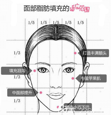 汕头华美面部脂肪填充适应范围图解 汕头华美面部脂肪填充适应范围图解