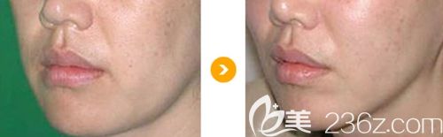 韩国清谭优韩面部埋线提升案例 韩国清谭优韩面部埋线提升案例