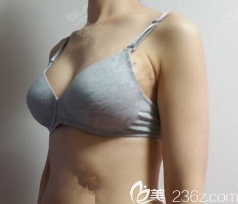 韩国世大特整形吴东锡水滴假体自体脂肪填充隆胸后让我有了做女人的自信