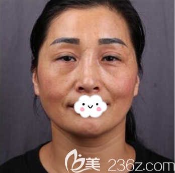 成都军大整形外科医院赵善军术前照片1