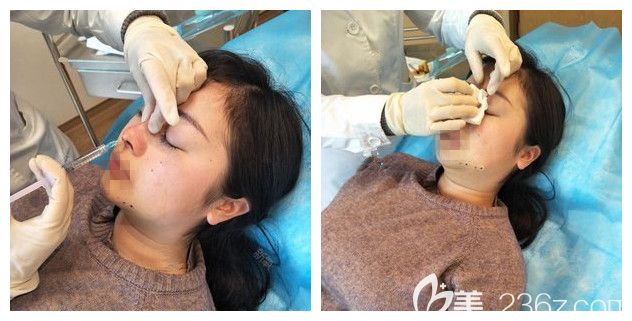 南京美莱医生注射玻尿酸隆鼻