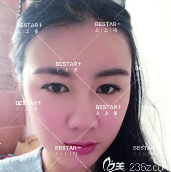 在北京上上相做蜂巢明星艺术面雕和双眼皮手术一个月效果 在北京上上相做蜂巢明星艺术面雕和双眼皮手术一个月效果