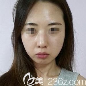 我在韩国必妩做纳米双颚手术+额头填充+隆鼻实例 我在韩国必妩做纳米双颚手术+额头填充+隆鼻实例