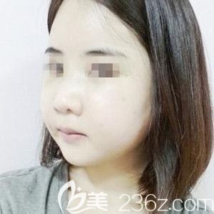 我在韩国必妩做纳米双颚手术+额头填充+隆鼻术后恢复 我在韩国必妩做纳米双颚手术+额头填充+隆鼻术后恢复