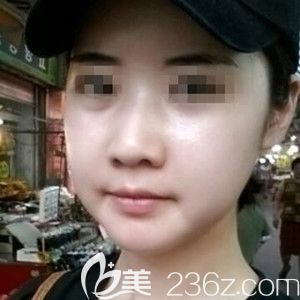 我在韩国必妩做纳米双颚手术+额头填充恢复情况 我在韩国必妩做纳米双颚手术+额头填充恢复情况