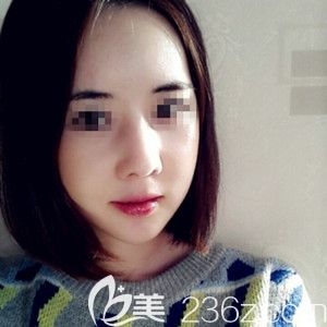 我在韩国必妩做纳米双颚手术+额头填充术后实例 我在韩国必妩做纳米双颚手术+额头填充术后实例