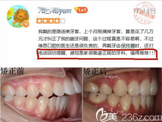 在做过隐适美矫正后的网评及矫正对比效果 在做过隐适美矫正后的网评及矫正对比效果