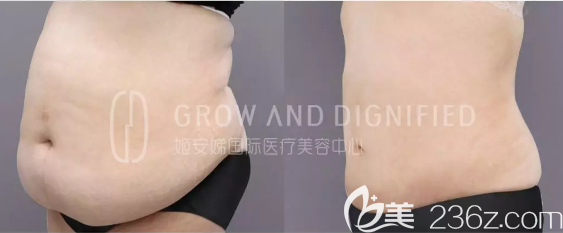 长春姬安娣整形吸脂瘦腹前后效果对比图