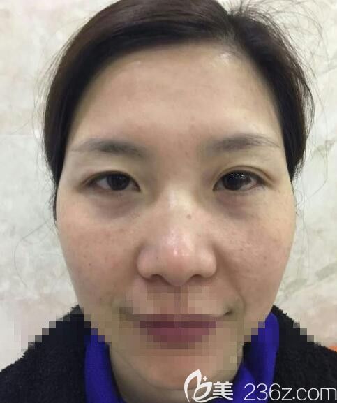 李冰院长做自体脂肪填充前 李冰院长做自体脂肪填充前