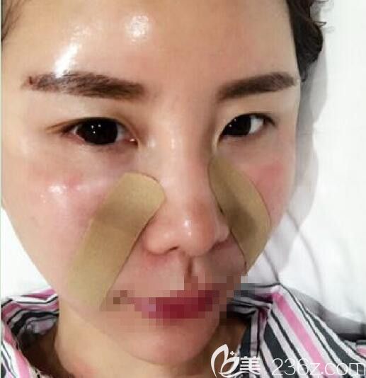 术后即刻效果明显 术后即刻效果明显