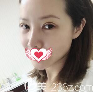 在长沙华韩华美做双眼皮修复术后效果 在长沙华韩华美做双眼皮修复术后效果