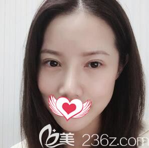 在长沙华韩华美做眼部修复+潘多拉眼部综合术后9天效果 在长沙华韩华美做眼部修复+潘多拉眼部综合术后9天效果