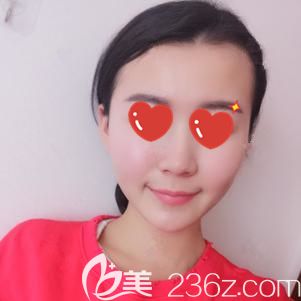 汪主任做光纤溶脂瘦脸术后35天脸部恢复自然