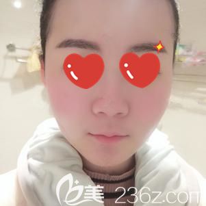 汪洋主任帮我做光纤溶脂术后效果