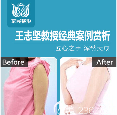 北京京民王志坚医生蝴蝶臂手臂抽脂塑形案例