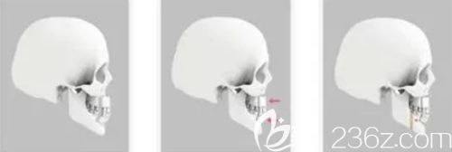 韩国双鄂手术原理